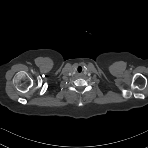 File:Chronic pulmonary embolus (Radiopaedia 39129-41341 Axial C+ CTPA 1).png