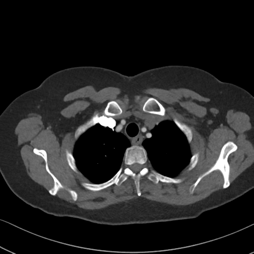 Chronic pulmonary embolus (Radiopaedia 39129-41341 Axial C+ CTPA 18).png