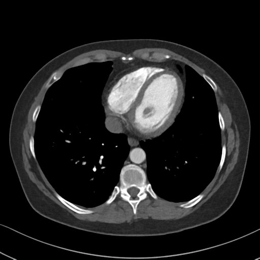 Chronic pulmonary embolus (Radiopaedia 39129-41341 Axial C+ CTPA 73).png