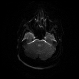 File:Chronic submandibular sialadenitis (Radiopaedia 61852-69885 Axial DWI 32).jpg