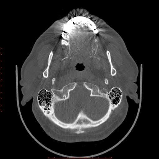 Chronic submandibular sialolithiasis (Radiopaedia 69817-79814 Axial bone window 9).jpg