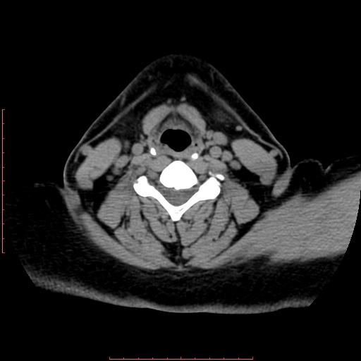 Chronic submandibular sialolithiasis (Radiopaedia 69817-79814 Axial non-contrast 157).jpg