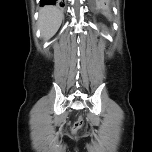 Chronic ureteropelvic junction obstruction (Radiopaedia 78365-90996 B 83).jpg