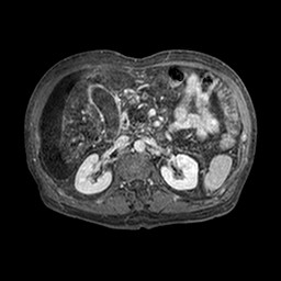 File:Cirrhosis and hepatocellular carcinoma in the setting of hemochromatosis (Radiopaedia 75394-86594 Axial T1 C+ fat sat 285).jpg