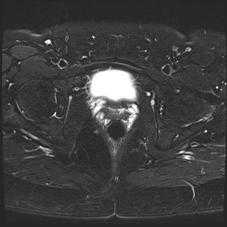 File:Class II Mullerian duct anomaly- unicornuate uterus with rudimentary horn and non-communicating cavity (Radiopaedia 39441-41755 Axial T2 fat sat 23).jpg