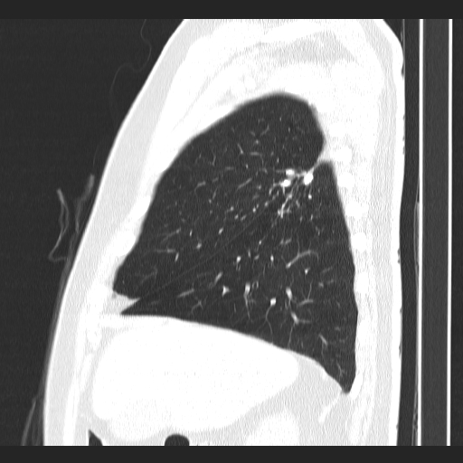 Classic complicated silicosis (Radiopaedia 49720-54961 Sagittal lung window 49).jpg