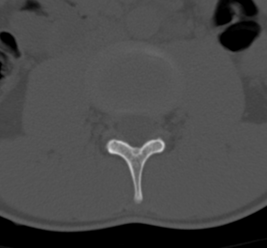 Clear cell meningoma - lumbar spine (Radiopaedia 60116-67691 Axial bone window 32).png
