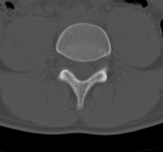 Clear cell meningoma - lumbar spine (Radiopaedia 60116-67691 Axial bone window 52).png
