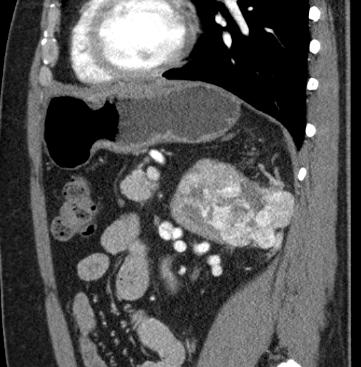 File:Clear cell renal cell carcinoma (Radiopaedia 61449-69393 D 34).jpg