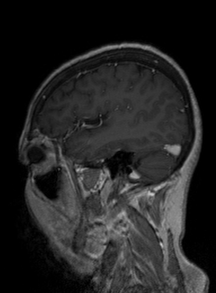 File:Clival meningioma (Radiopaedia 53278-59248 Sagittal T1 C+ 178).jpg