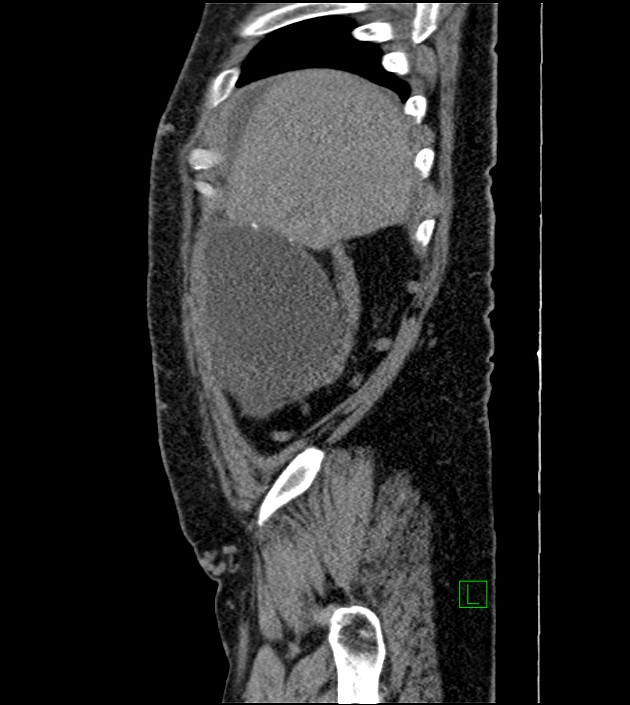 Closed-loop small bowel obstruction-internal hernia (Radiopaedia 78439-91096 C 122).jpg