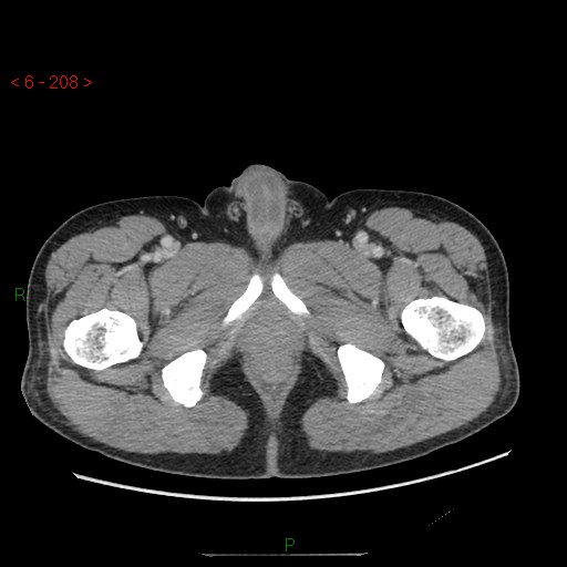 File:Closed loop obstruction and appendicular stump mucocele (Radiopaedia 54014-60163 A 127).jpg