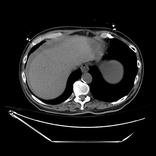 File:Closed loop obstruction due to adhesive band, resulting in small bowel ischemia and resection (Radiopaedia 83835-99023 Axial 153).jpg