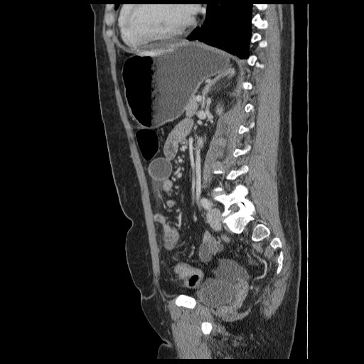 Closed loop small bowel obstruction (Radiopaedia 65403-74451 C 64).jpg