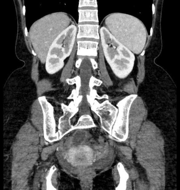 Closed loop small bowel obstruction (Radiopaedia 71211-81508 B 94).jpg