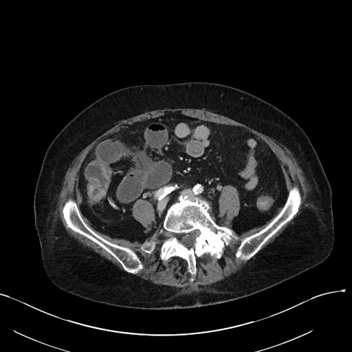 File:Closed loop small bowel obstruction - adhesions (Radiopaedia 59269-66611 A 85).jpg