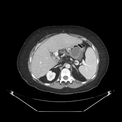Closed loop small bowel obstruction - internal hernia (Radiopaedia 65402-74450 A 32).jpg