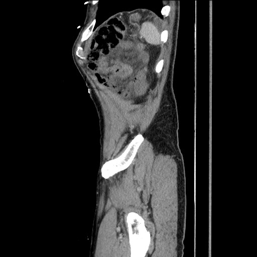 Closed loop small bowel obstruction - omental adhesion causing "internal hernia" (Radiopaedia 85129-100682 C 156).jpg