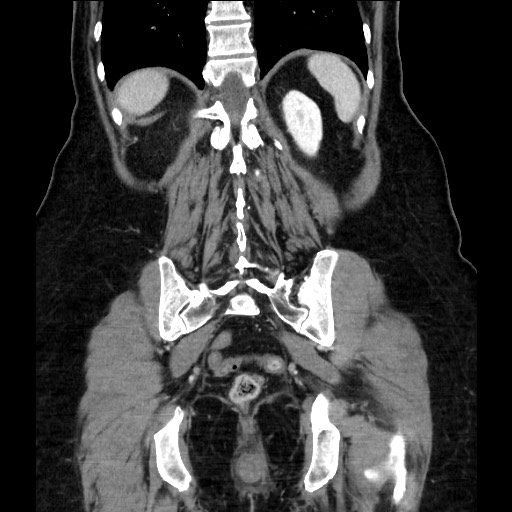 Closed loop small bowel obstruction due to adhesive bands - early and late images (Radiopaedia 83830-99014 B 97).jpg