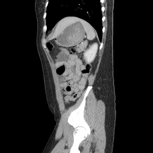 Closed loop small bowel obstruction due to trans-omental herniation (Radiopaedia 35593-37109 C 52).jpg