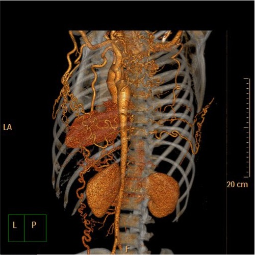 File:Coarctation of the aorta (Radiopaedia 40877-43571 A 5).jpg