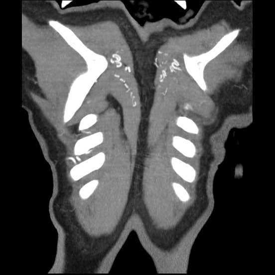 Coarctation of the aorta (Radiopaedia 67609-77010 B 4).jpg