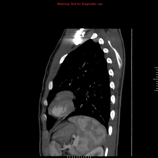 File:Coarctation of the aorta (Radiopaedia 9434-10118 B 53).jpg