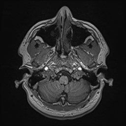 File:Cochlear incomplete partition type III associated with hypothalamic hamartoma (Radiopaedia 88756-105498 Axial T1 41).jpg