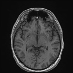 Cochlear incomplete partition type III associated with hypothalamic hamartoma (Radiopaedia 88756-105498 Axial T1 97).jpg