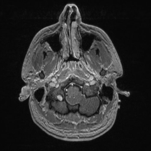 File:Colloid cyst (Radiopaedia 44510-48181 Axial T1 C+ 32).png