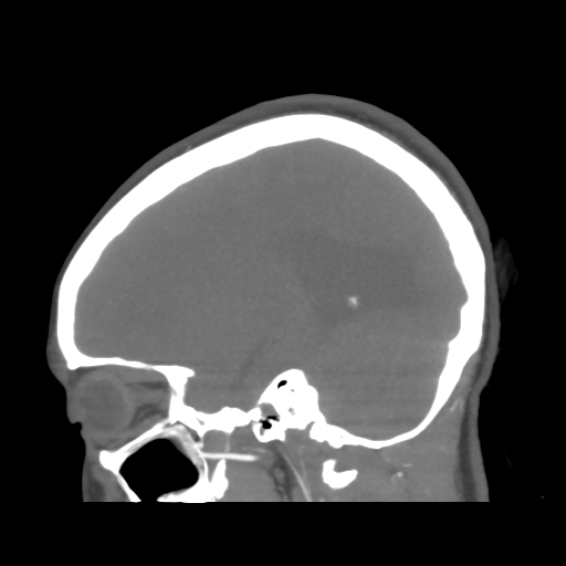 File:Colloid cyst (resulting in death) (Radiopaedia 33423-34499 B 18).png