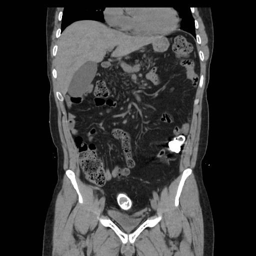 File:Colocutaneous fistula in Crohn's disease (Radiopaedia 29586-30093 E 14).jpg