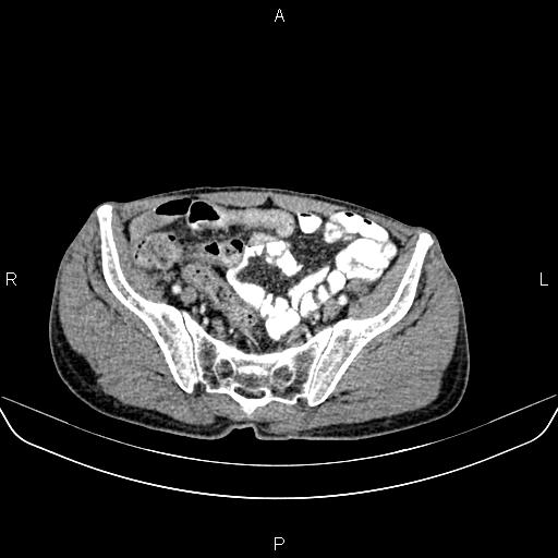 File:Colon adenocarcinoma - hepatic flexure (Radiopaedia 85635-101395 A 76).jpg