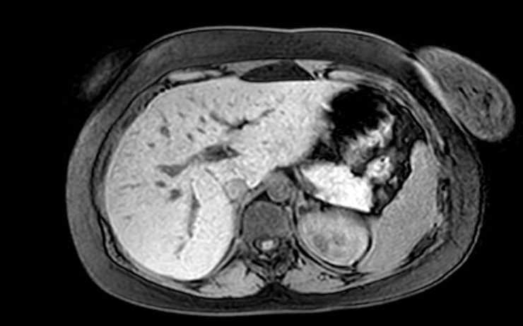 Colon adenocarcinoma with Krukenberg tumors, advanced pregnancy (Radiopaedia 67279-76645 A 65).jpg