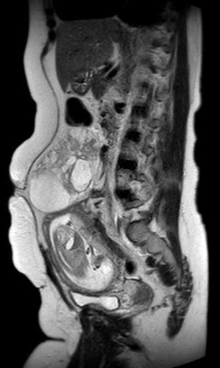 Colon adenocarcinoma with Krukenberg tumors, advanced pregnancy (Radiopaedia 67279-76645 Sagittal T2 23).jpg