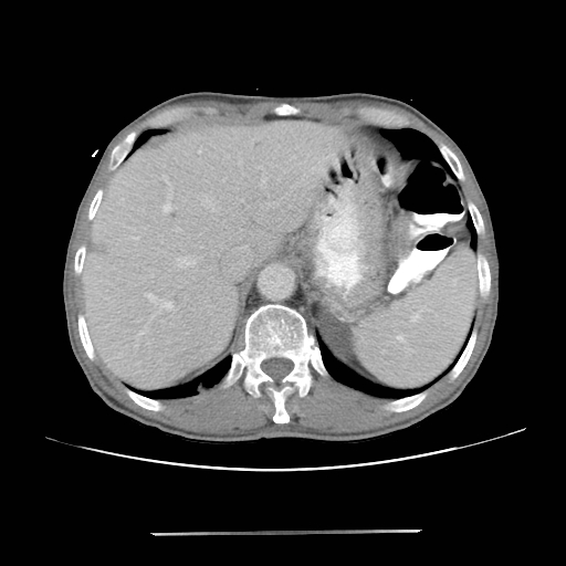 Colon cancer with calcified liver metastasis (Radiopaedia 74423-85307 A 16).jpg