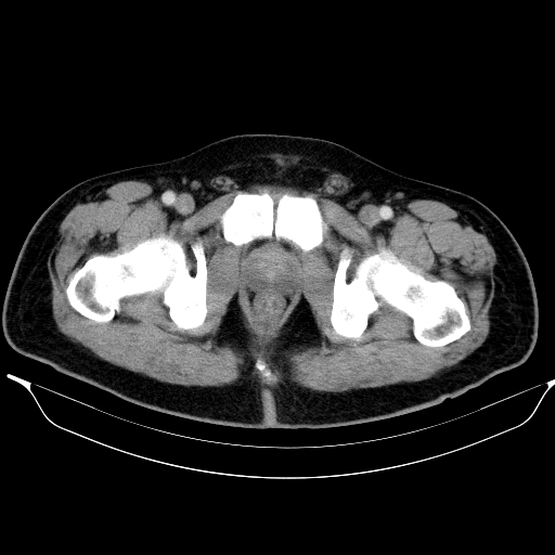 Colonic lipoma with colo-colic intussusception (Radiopaedia 58944-66200 A 69).jpg