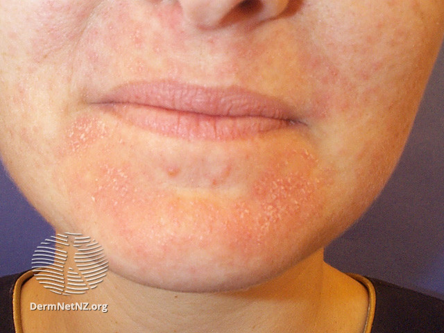 File:Dryness due to topical retinoid (DermNet NZ treatments-top-ret-dry).jpg