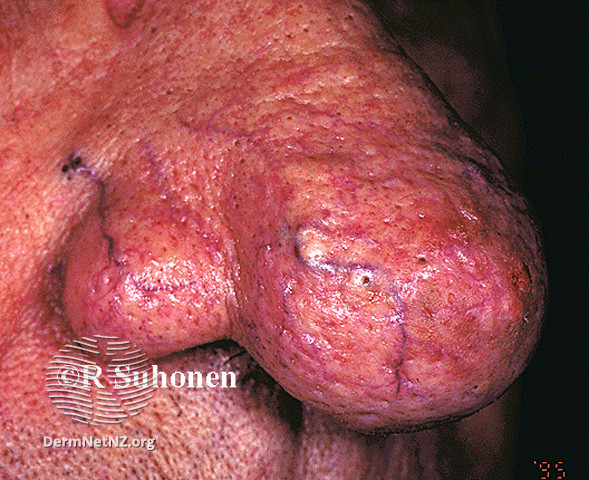 File:Grade 1 (DermNet NZ acne-s-rhinophyma-01).jpg