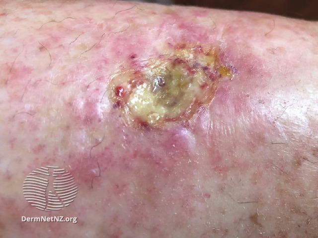 File:Hydroxyurea-induced leg ulcer (DermNet NZ hydroxyurea-ulcer2).jpg