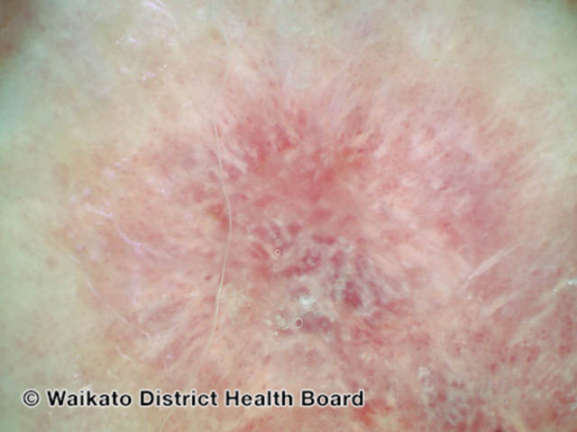 File:Intraepidermal carcinoma, polarised dermoscopy view (DermNet NZ 180044).jpg