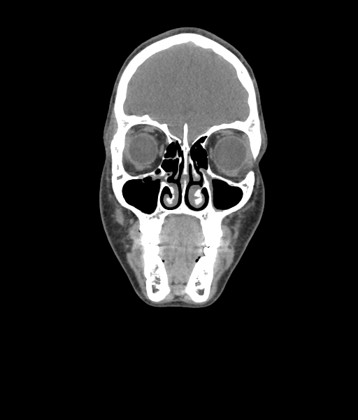 Nasal pyogenic granuloma (lobular capillary hemangioma) (Radiopaedia 85536-101244 Coronal non-contrast 70).jpg