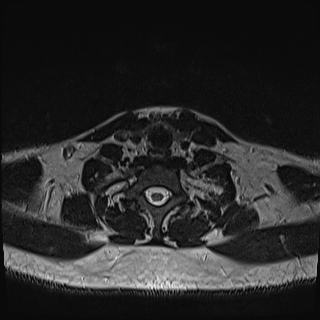 Nasopharyngeal carcinoma with perineural spread (Radiopaedia 55030-61380 Axial T2 76).jpg