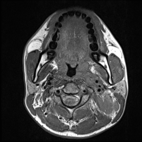 File:Nasopharyngeal carcinoma with skull base invasion (Radiopaedia 53415-59485 Axial T1 40).jpg