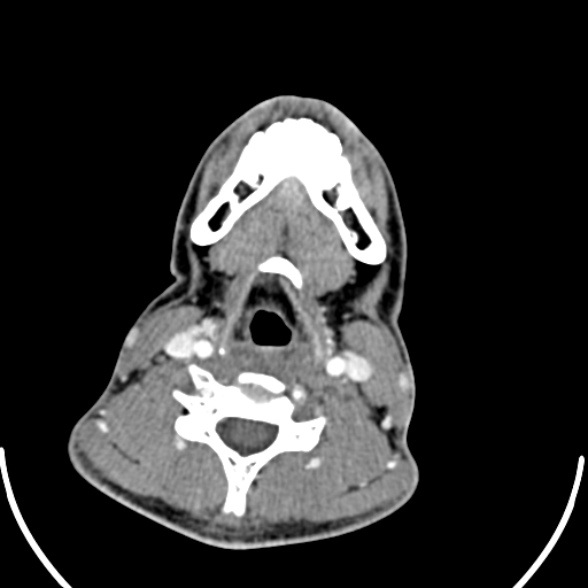 Nasopharyngeal carcinoma with skull base invasion (Radiopaedia 53415-59705 A 138).jpg