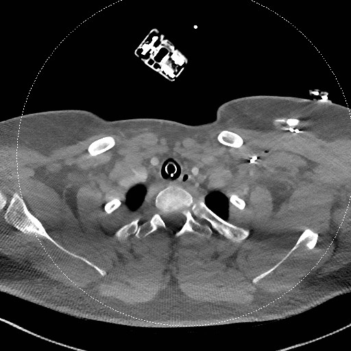 Neck CT angiogram (intraosseous vascular access) (Radiopaedia 55481-61945 B 102).jpg