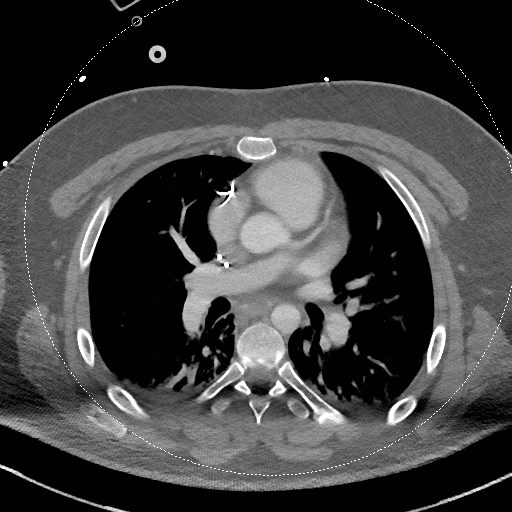 Neck CT angiogram (intraosseous vascular access) (Radiopaedia 55481-61945 B 14).jpg