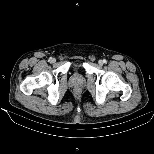 Necrotizing pancreatitis (Radiopaedia 87796-104249 A 57).jpg