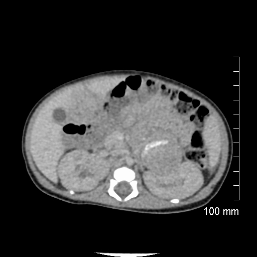 File:Neonatal neuroblastoma (Radiopaedia 56651-63438 Axial non-contrast 35).jpg