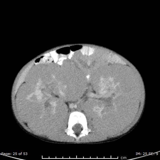 File:Nephroblastomatosis (Radiopaedia 41934-44935 A 25).jpg